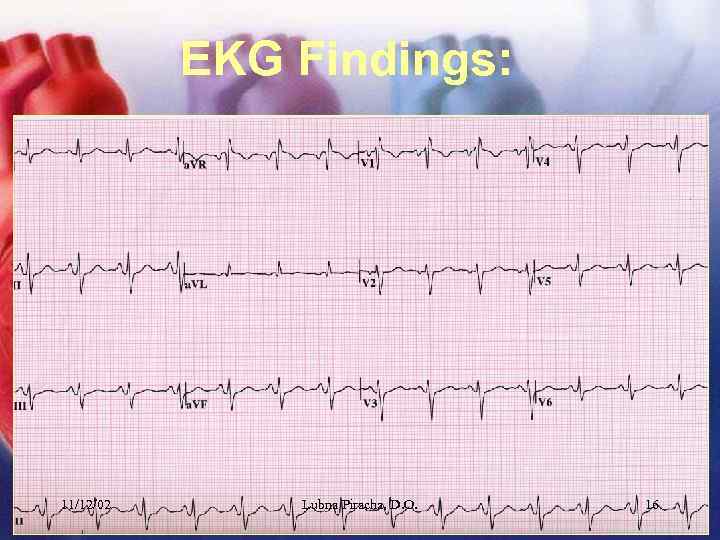 EKG Findings: 11/12/02 Lubna Piracha, D. O. 16 
