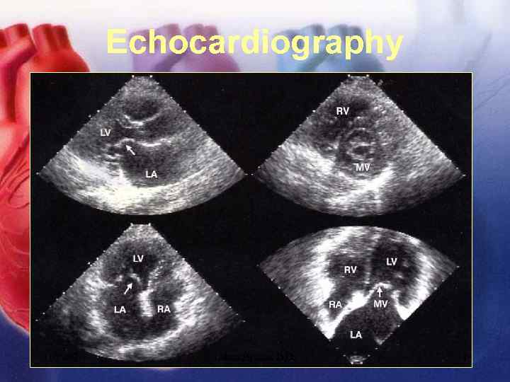 Echocardiography 11/12/02 Lubna Piracha, D. O. 18 