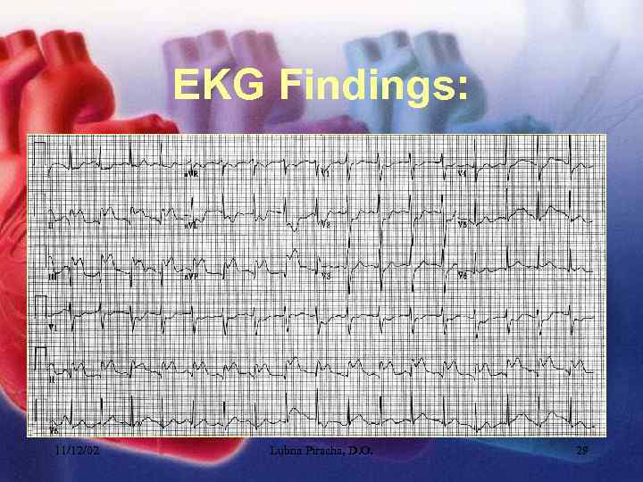 EKG Findings: 11/12/02 Lubna Piracha, D. O. 29 