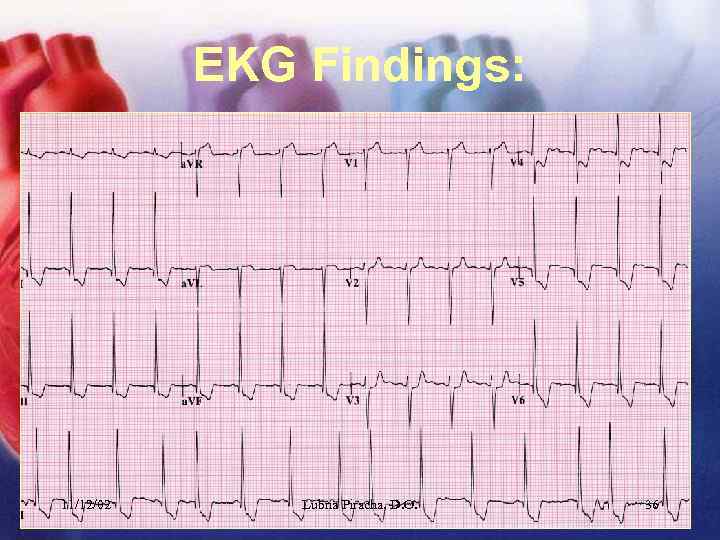 EKG Findings: 11/12/02 Lubna Piracha, D. O. 36 