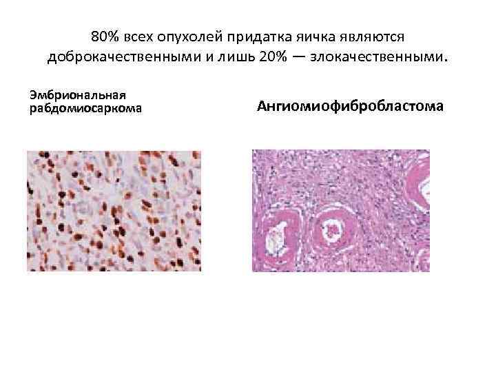 Злокачественная опухоль картинки