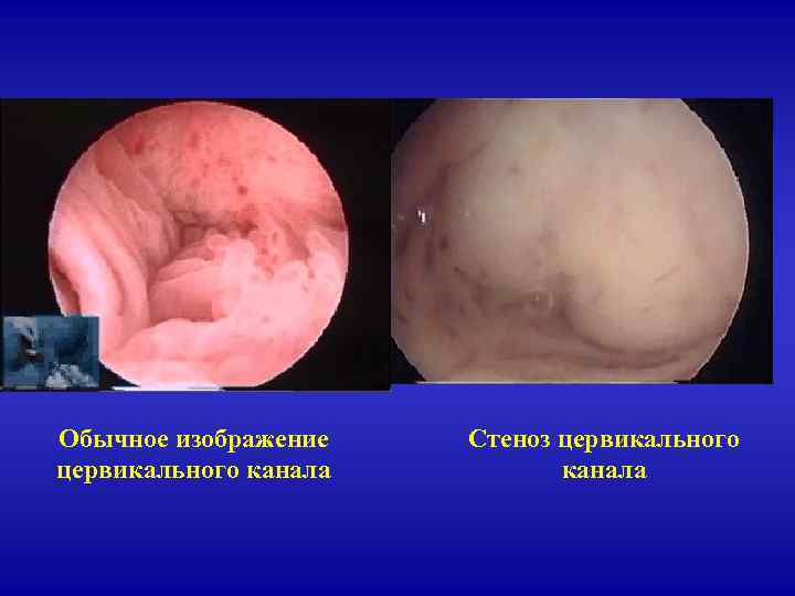 Обычное изображение цервикального канала Стеноз цервикального канала 