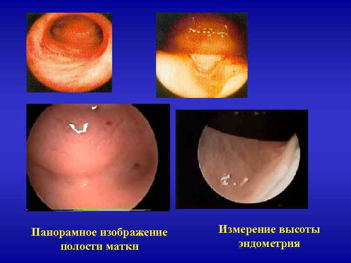 Панорамное изображение полости матки Измерение высоты эндометрия 