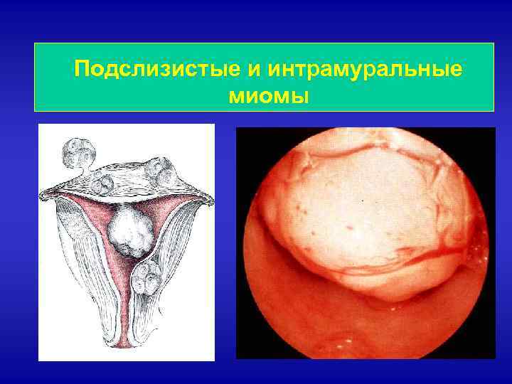 Подслизистые и интрамуральные миомы 