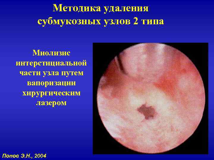 Методика удаления субмукозных узлов 2 типа Миолизис интерстициальной части узла путем вапоризации хирургическим лазером