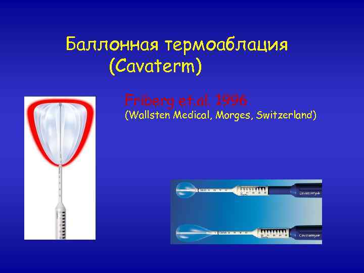 Баллонная термоаблация (Cavaterm) Friberg et. al. 1996 (Wallsten Medical, Morges, Switzerland) 