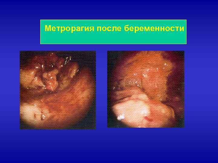 Метрорагия после беременности 