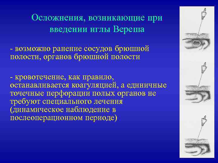 Осложнения, возникающие при введении иглы Вереша - возможно ранение сосудов брюшной полости, органов брюшной