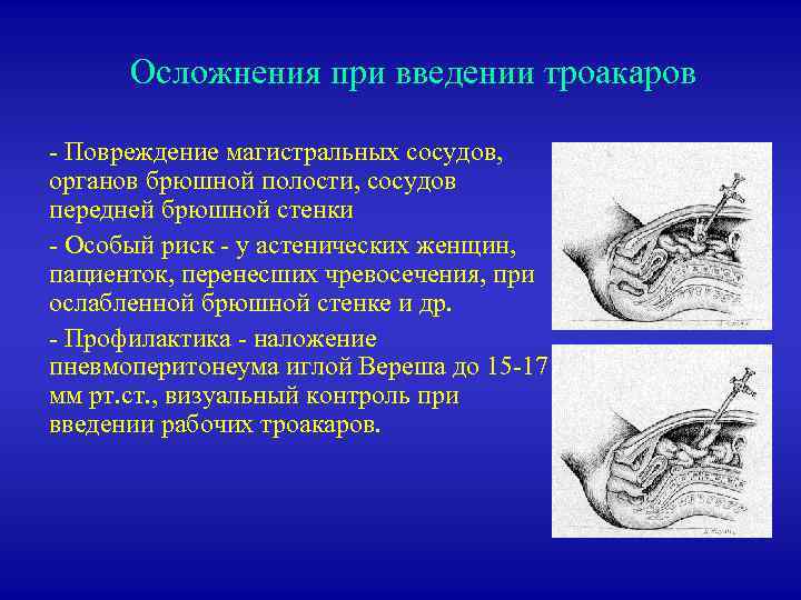 Осложнения при введении троакаров - Повреждение магистральных сосудов, органов брюшной полости, сосудов передней брюшной