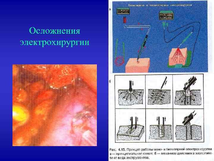 Осложнения электрохирургии 