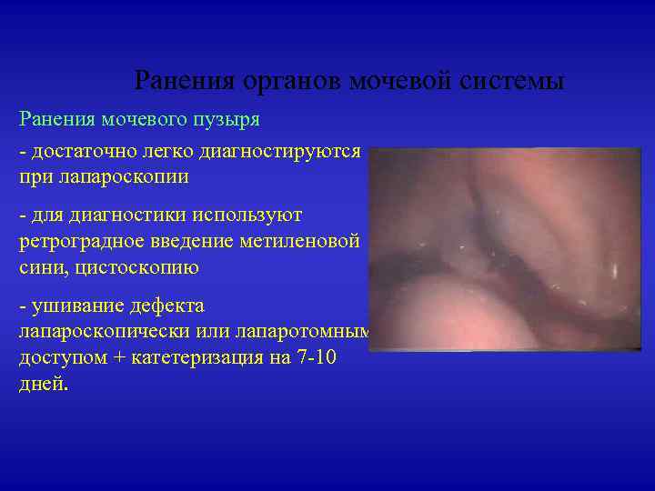 Ранения органов мочевой системы Ранения мочевого пузыря - достаточно легко диагностируются при лапароскопии -