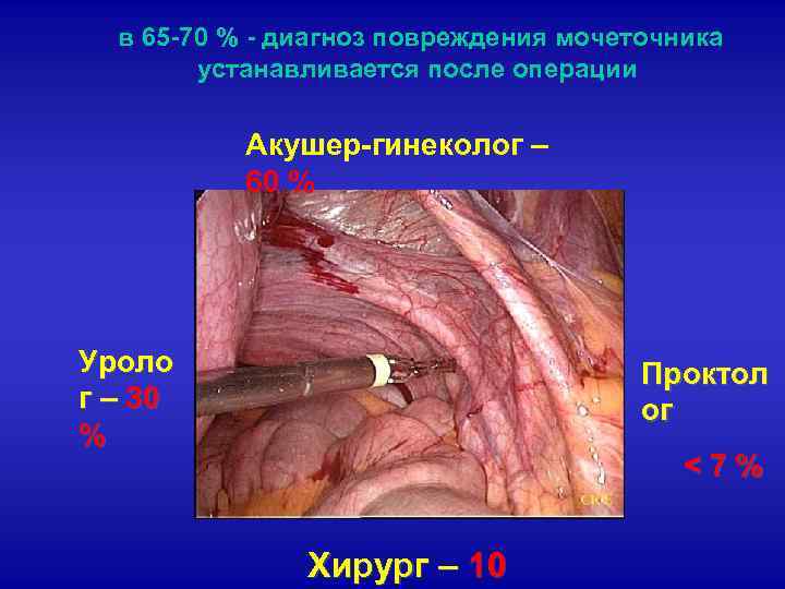 в 65 -70 % - диагноз повреждения мочеточника устанавливается после операции Акушер-гинеколог – 60