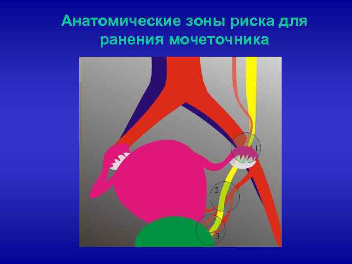 Анатомические зоны риска для ранения мочеточника 