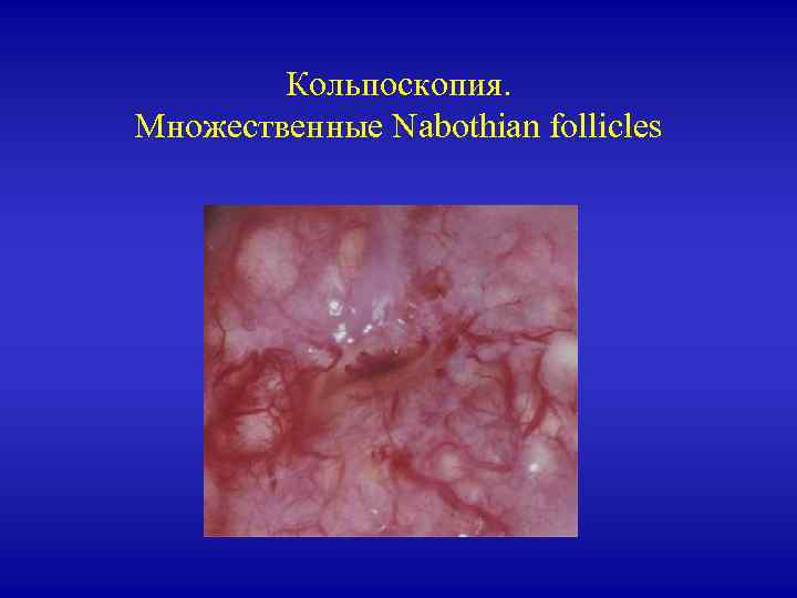 Кольпоскопия. Множественные Nabothian follicles 