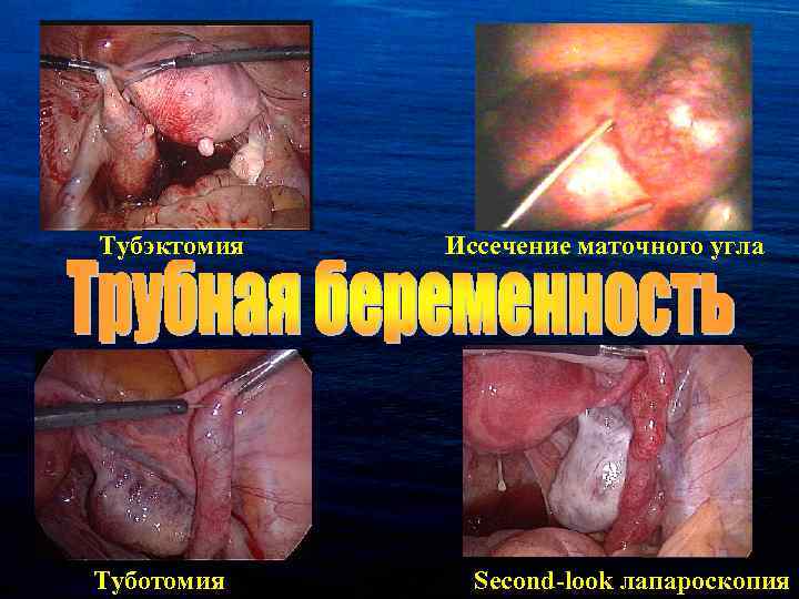 Тубэктомия Туботомия Иссечение маточного угла Second-look лапароскопия 