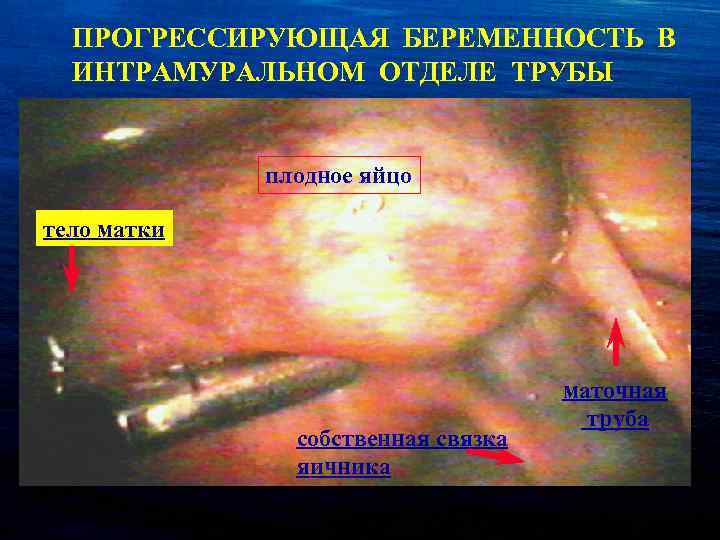 ПРОГРЕССИРУЮЩАЯ БЕРЕМЕННОСТЬ В ИНТРАМУРАЛЬНОМ ОТДЕЛЕ ТРУБЫ плодное яйцо тело матки собственная связка яичника маточная