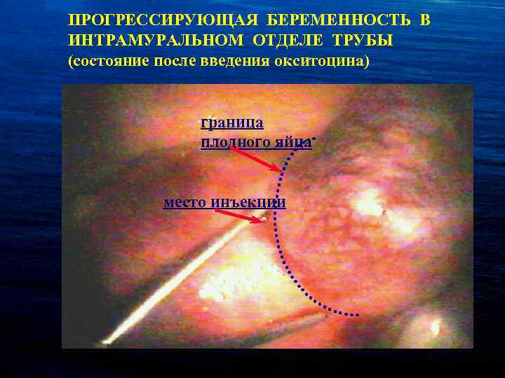 ПРОГРЕССИРУЮЩАЯ БЕРЕМЕННОСТЬ В ИНТРАМУРАЛЬНОМ ОТДЕЛЕ ТРУБЫ (состояние после введения окситоцина) граница плодного яйца место