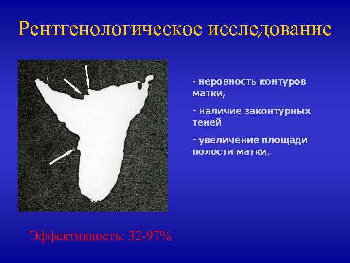 Рентгенологическое исследование - неровность контуров матки, - наличие законтурных теней - увеличение площади полости