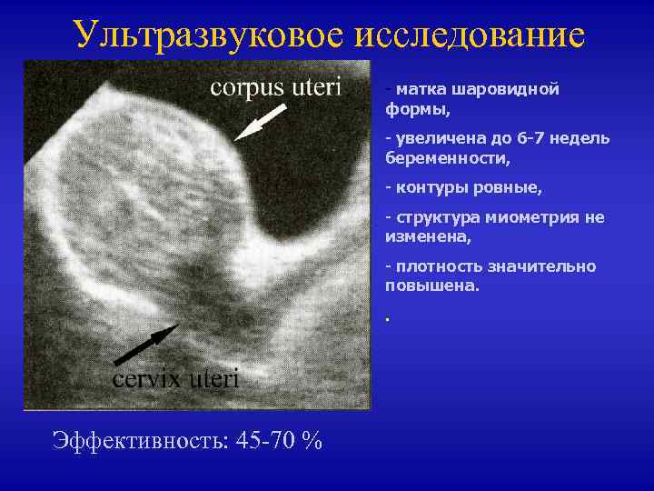 Матка увеличена до 6 недель. Ретроцервикальный эндометриоз по УЗИ. Матка шарообразной формы. Форма матки шаровидная на УЗИ.