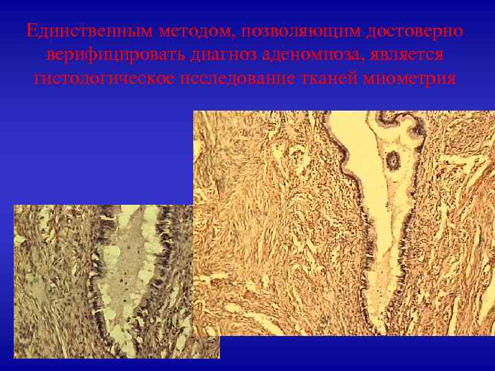 Единственным методом, позволяющим достоверно верифицировать диагноз аденомиоза, является гистологическое исследование тканей миометрия 