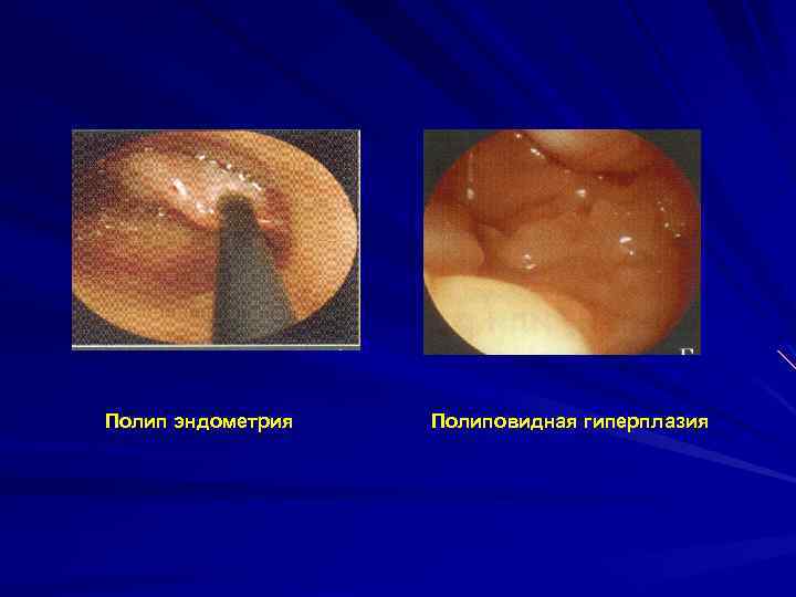Полип эндометрия Полиповидная гиперплазия 