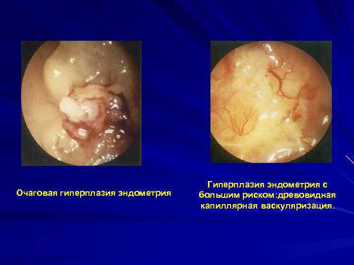 Очаговая гиперплазия эндометрия Гиперплазия эндометрия с большим риском: древовидная капиллярная васкуляризация. 