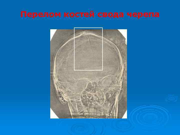 Перелом костей свода черепа 