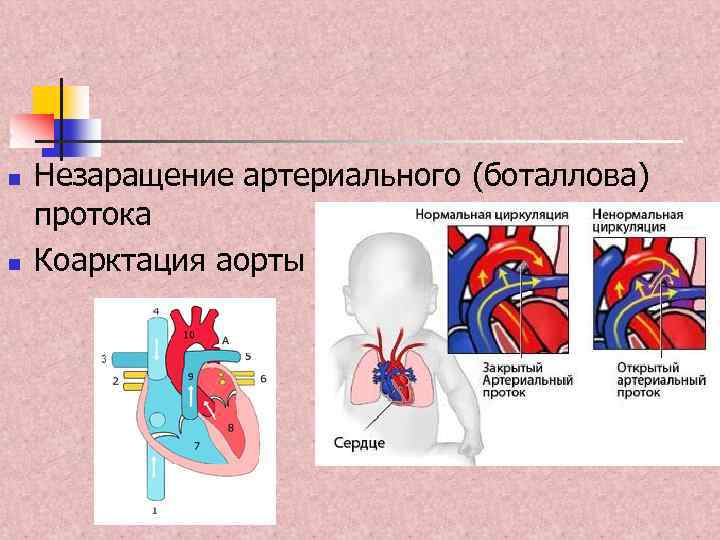 n n Незаращение артериального (боталлова) протока Коарктация аорты 