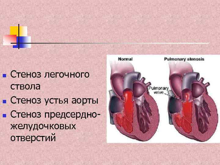 n n n Стеноз легочного ствола Стеноз устья аорты Стеноз предсердножелудочковых отверстий 