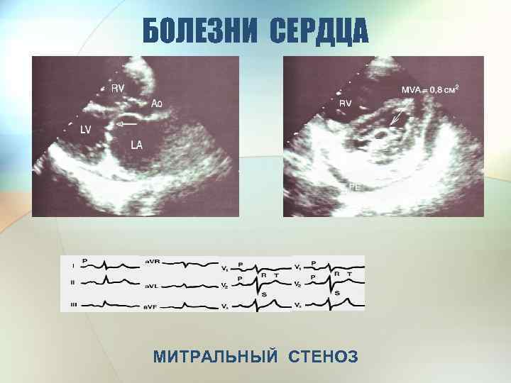 БОЛЕЗНИ СЕРДЦА МИТРАЛЬНЫЙ СТЕНОЗ 