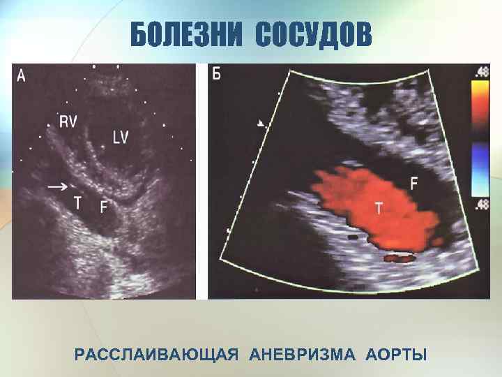 БОЛЕЗНИ СОСУДОВ РАССЛАИВАЮЩАЯ АНЕВРИЗМА АОРТЫ 