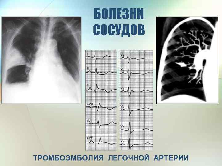 Тромбоэмболия мелких ветвей легочной артерии. Тэла рентгенологическая картина.