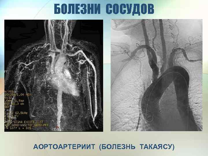 Артериит такаясу презентация