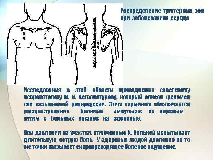 Распределение триггерных зон при заболеваниях сердца Исследования в этой области принадлежат советскому невропатологу М.