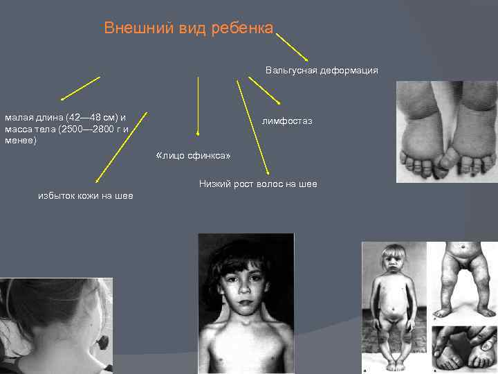  Внешний вид ребенка Вальгусная деформация малая длина (42— 48 см) и масса тела