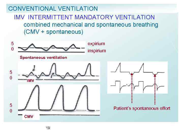 CONVENTIONAL VENTILATION IMV INTERMITTENT MANDATORY VENTILATION combined mechanical and spontaneous breathing (CMV + spontaneous)