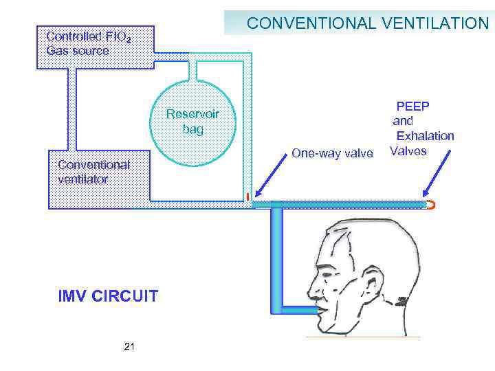 CONVENTIONAL VENTILATION Controlled FIO 2 Gas source Reservoir bag Conventional ventilator IMV CIRCUIT 21