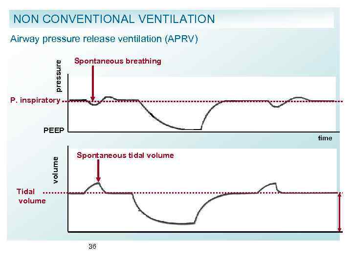 NON CONVENTIONAL VENTILATION pressure Airway pressure release ventilation (APRV) Spontaneous breathing P. inspiratory volume