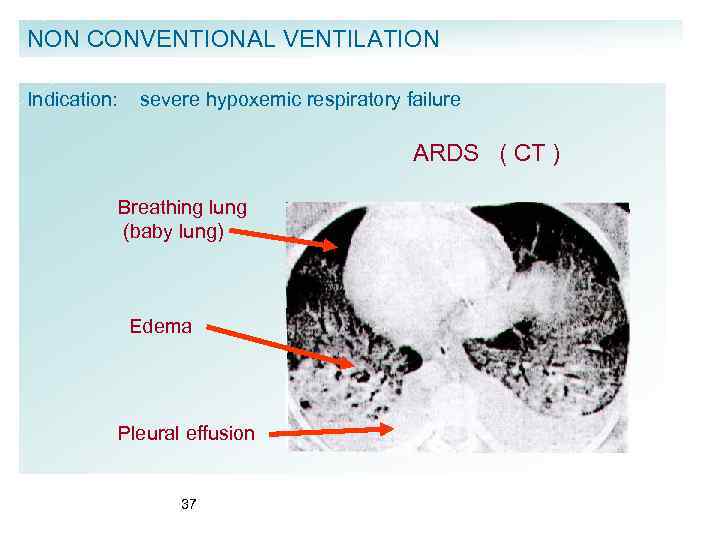 NON CONVENTIONAL VENTILATION Indication: severe hypoxemic respiratory failure ARDS ( CT ) Breathing lung