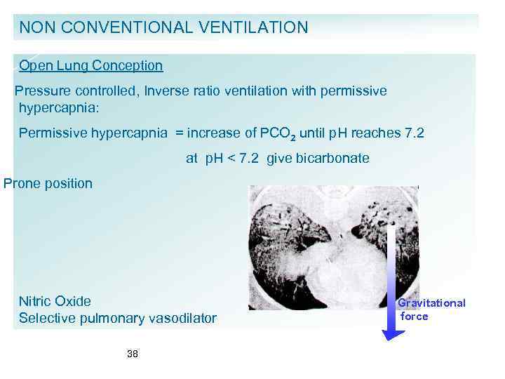 NON CONVENTIONAL VENTILATION Open Lung Conception Pressure controlled, Inverse ratio ventilation with permissive hypercapnia: