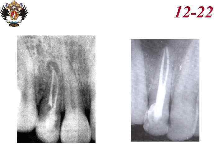 Анатомия корневых каналов презентация