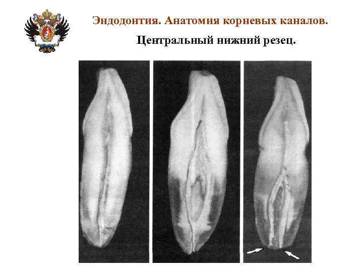 Анатомия корневых каналов презентация