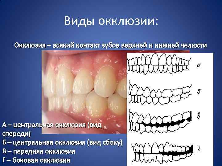 Виды окклюзии: Окклюзия – всякий контакт зубов верхней и нижней челюсти А – центральная