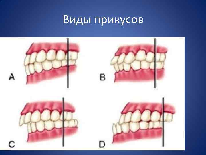 Виды прикусов 