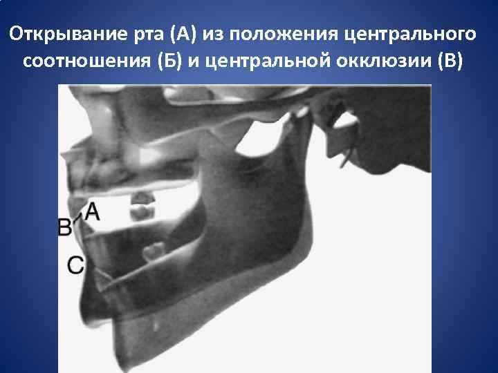 Открывание рта (А) из положения центрального соотношения (Б) и центральной окклюзии (В) 