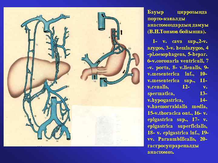 Бауыр циррозында порто-кавалды анастомоздардың дамуы (В. Н. Тонков бойынша). 1 - v. cava sup.