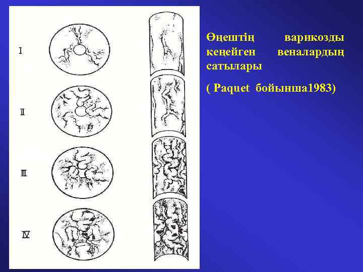 Өңештің кеңейген сатылары варикозды веналардың ( Paquet бойынша 1983) 