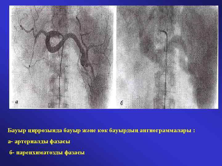 Бауыр циррозында бауыр және көк бауырдың ангиограммалары : а- артериалды фазасы б- паренхиматозды фазасы