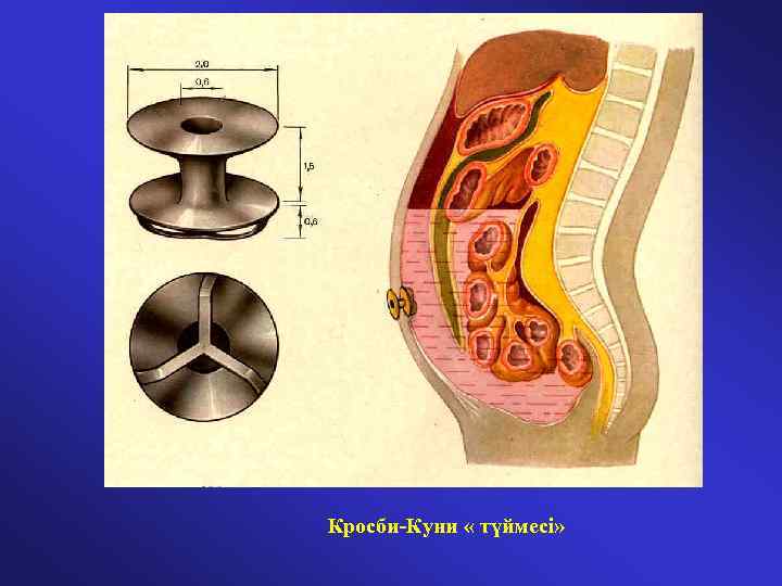 Кросби-Куни « түймесі» 