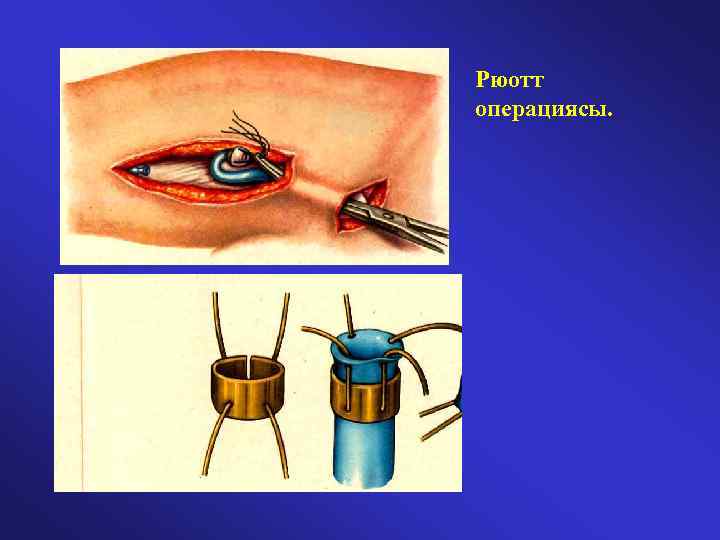 Рюотт операциясы. 